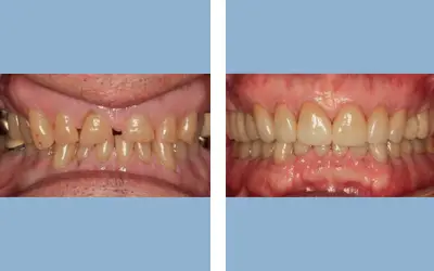 Before and After